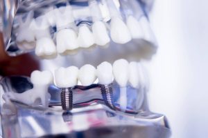 Ile kosztują sztuczne zęby?