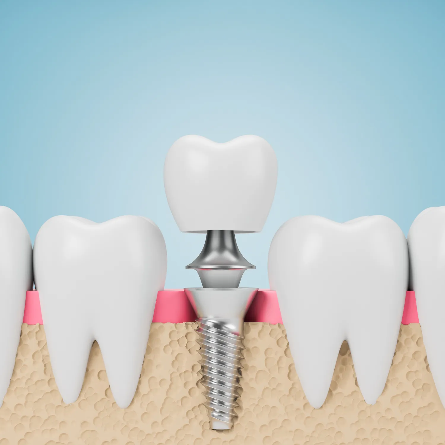 Jaki jest koszt implantów całej szczęki?